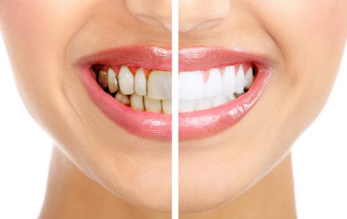 Tẩy trắng răng được bao lâu? 1