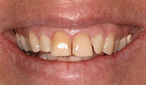 Tẩy trắng răng mất bao lâu thời gian? 1