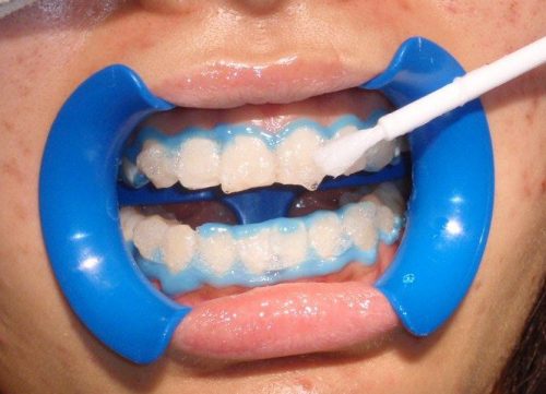 Tẩy trắng răng như thế nào? 4