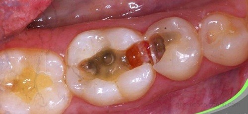Nhổ răng hàm có ảnh hưởng gì không? 1