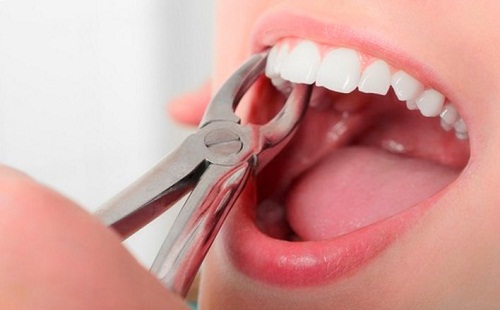 Nhổ răng hàm có ảnh hưởng gì không? 2