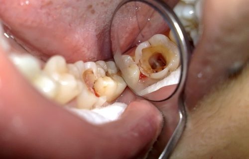 Nhổ răng hàm không đau bằng công nghệ mới 1