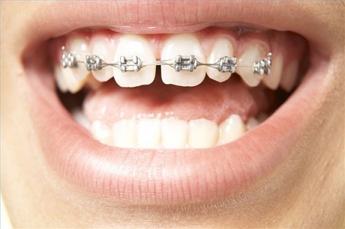Niềng răng có đau không? Cần lưu ý gì khi niềng răng? 1