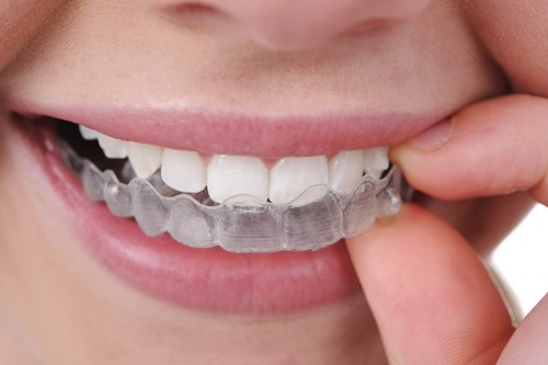 Niềng răng mất bao lâu là có kết quả? 1