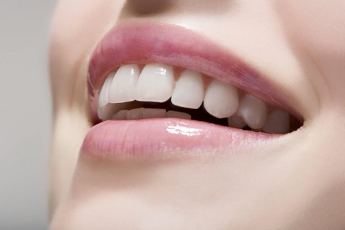 Niềng răng mất bao lâu là có kết quả? 2