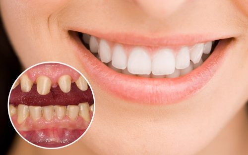 Bọc răng sứ thẩm mỹ - Giải pháp cho hàm răng kém duyên 1