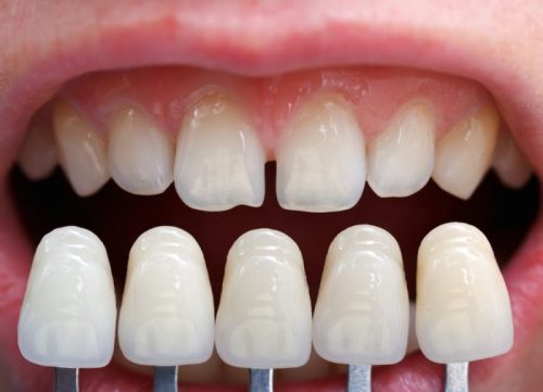 Bọc răng sứ cả hàm có thực hiện được không? 2