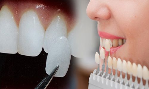 Bọc răng sứ cả hàm có thực hiện được không? 3