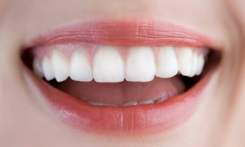 Bọc răng sứ cercon khắc phục các khiếm khuyết răng 1