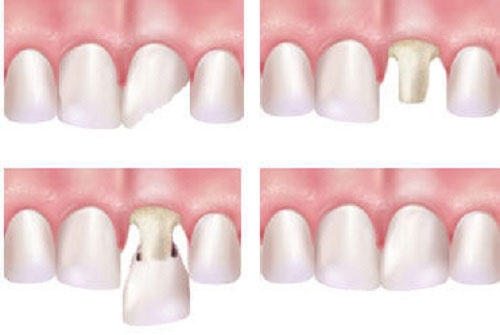 Bọc răng sứ cercon khắc phục các khiếm khuyết răng 2