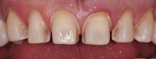 Bọc răng sứ cercon khắc phục các khiếm khuyết răng 4