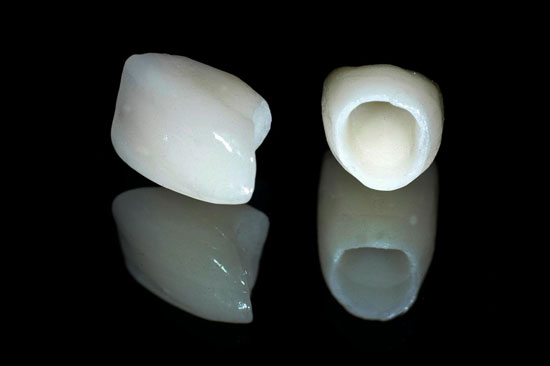 Bọc răng sứ cercon khắc phục các khiếm khuyết răng 5