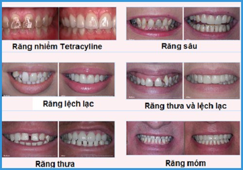 Bọc răng sứ có ảnh hưởng gì không? 2