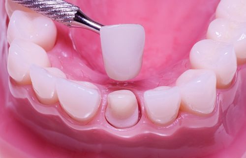 Bọc răng sứ có ảnh hưởng gì không? 3