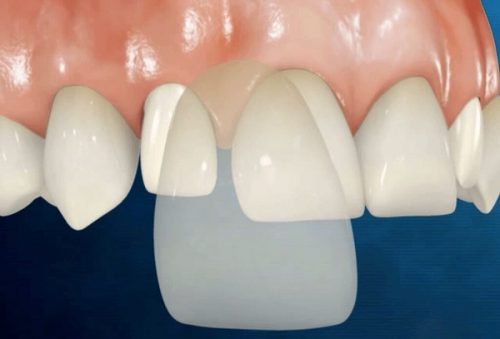 Bọc răng sứ không cần mài răng thông tin từ nha khoa 2