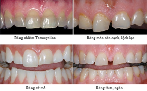 Bọc răng sứ không cần mài răng thông tin từ nha khoa 4
