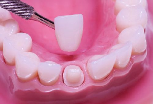 Bọc răng sứ titan là gì? Thực hiện như thế nào an toàn? 3