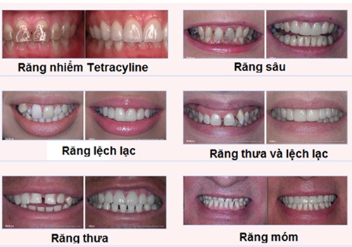 Chụp răng sứ giá bao nhiêu là chuẩn nhất? 2