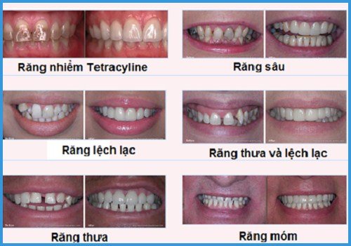 Giá bọc răng sứ zirconia tại nha khoa đạt chuẩn 1