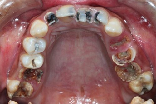 Nhổ răng sâu hàm dưới được chỉ định khi nào? 2