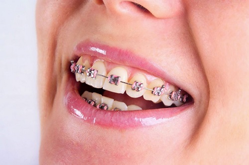 Có nên niềng răng cho người trưởng thành không?
