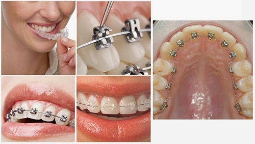 Niềng răng có ảnh hưởng đến sức khỏe không? 2