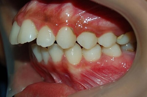 Niềng răng hô với các loại hình chỉnh nha phổ biến 1
