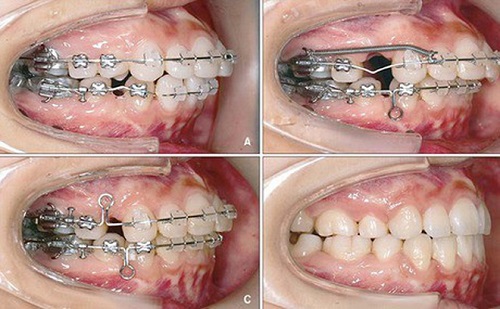 Niềng răng hô với các loại hình chỉnh nha phổ biến 4