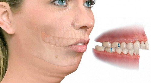 Vì sao nên thực hiện niềng răng hô hàm trên? 2