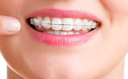 Vì sao nên thực hiện niềng răng hô hàm trên? 3