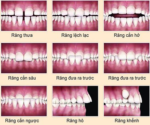 Niềng răng invisalign tại nha khoa Đăng Lưu 1