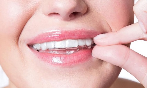 Niềng răng invisalign có đau không? 3