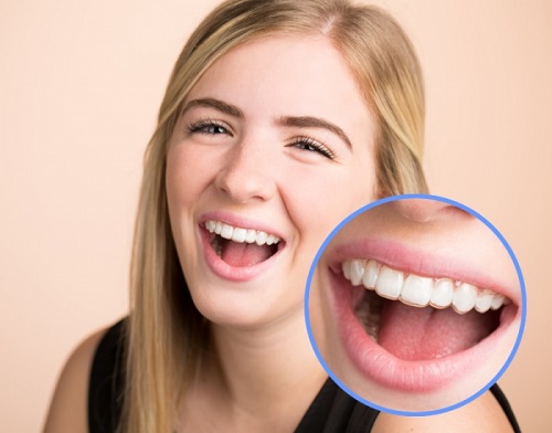 Niềng răng invisalign có tốt không? 1