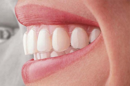 Niềng răng invisalign có tốt không? 3