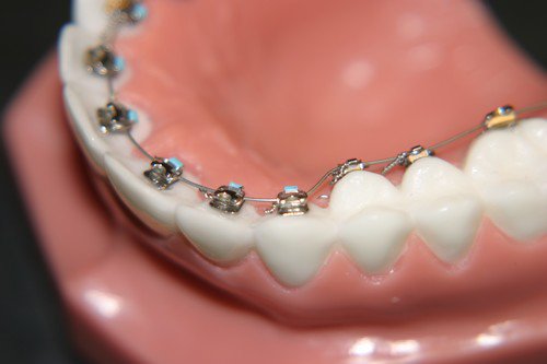 Niềng răng khểnh giá bao nhiêu là hợp lý nhất?