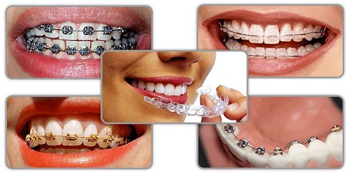Niềng răng khểnh giá bao nhiêu là hợp lý nhất? 3