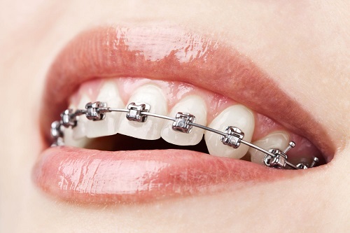 Niềng răng là gì? Quy trình niềng răng thế nào? 1