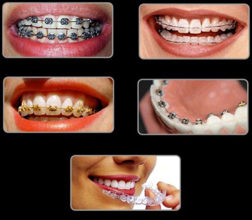 Niềng răng là gì? Quy trình niềng răng thế nào? 1