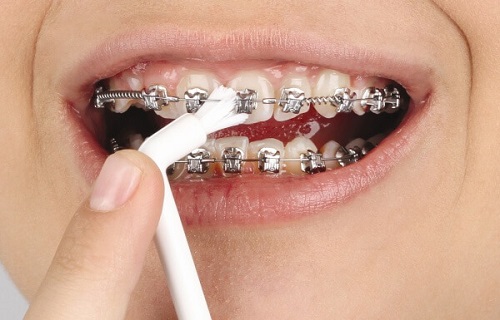 Niềng răng là gì? Quy trình niềng răng thế nào? 4