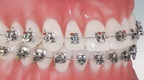 Niềng răng mắc cài inox theo quy trình chuẩn 1
