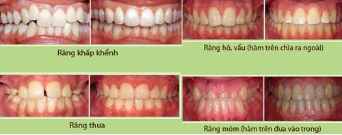 Niềng răng mắc cài inox theo quy trình chuẩn 2