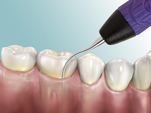 Niềng răng mắc cài inox theo quy trình chuẩn 3