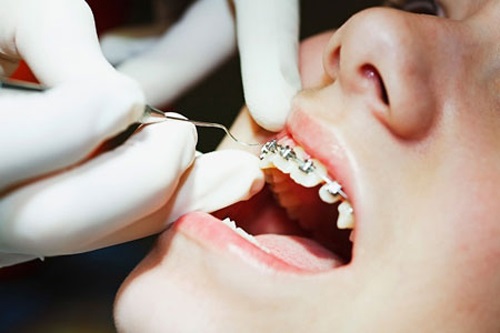 Niềng răng mắc cài inox theo quy trình chuẩn 4