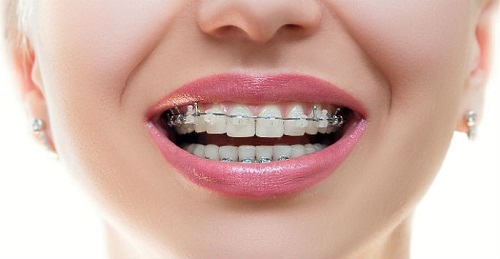 Niềng răng mắc cài sứ - Kỹ thuật chỉnh nha được yêu thích 4