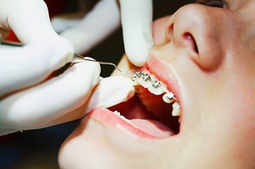 Thông tin về kỹ thuật niềng răng móm cho khách hàng 3