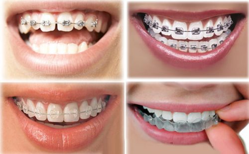 Niềng răng thưa giá bao nhiêu là được nhất hiện nay? 3 Niềng răng thưa giá bao nhiêu là được nhất hiện nay? 3