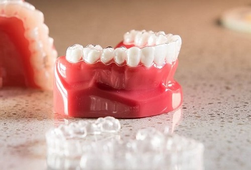 Niềng răng trong suốt là phương pháp gì? Ưu điểm 1