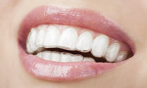Niềng răng trong suốt là phương pháp gì? Ưu điểm 4