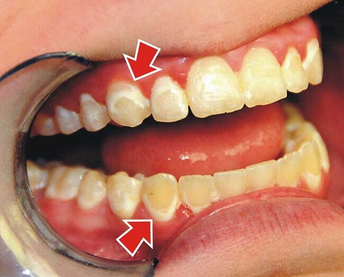 Một số tác hại của việc tẩy trắng răng không đảm bảo 1