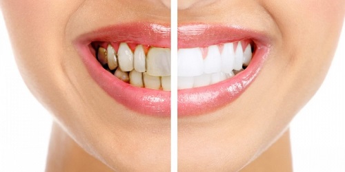 Một số tác hại của việc tẩy trắng răng không đảm bảo 2